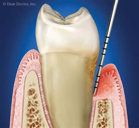 Pocket dentistry. Things To Know About Pocket dentistry. 